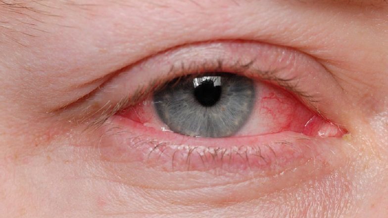 Eye Infection Alert! पुणे में तेजी से फैल रहा आंख का इन्फेक्शन, 1600 बच्चे कंजंक्टिवाइटिस से प्रभावित, स्कूलों से छुट्टी की अपील