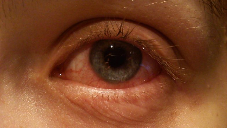 Eye Flu Case: बिहार में 'आई फ्लू' का कहर, तेजी से बढ़ी मरीजों की संख्या