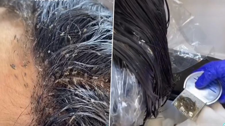 Viral Video: लाखों जूं और लीखों से भरा दिखा बच्ची का पूरा सिर, वीडियो देख आपको भी आ जाएगी घिन्न