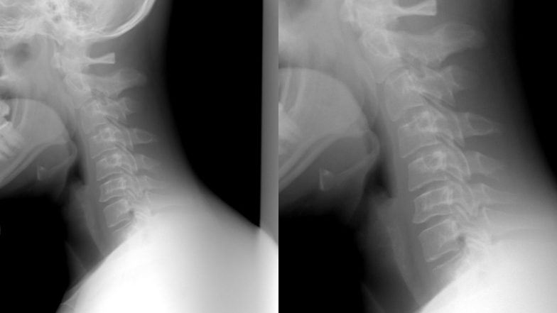 Windpipe Tears Due to Hold Sneeze: छींक रोकने के चक्कर में अस्पताल पहुंचा शख्स, भारी दबाव के चलते फटी श्वास नली