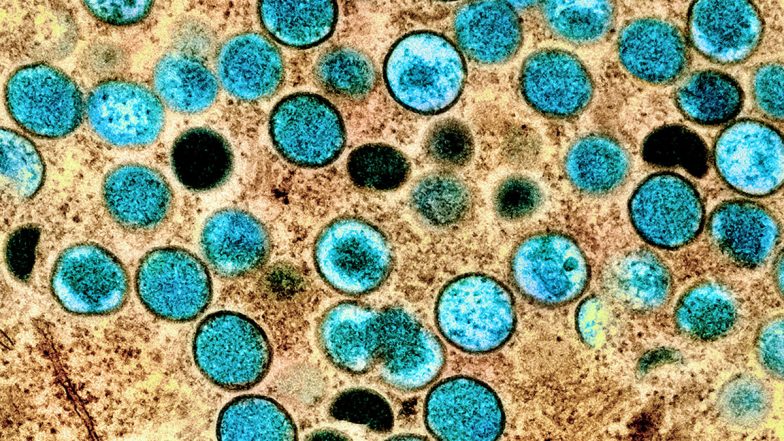 Monkeypox Case: इज़रायल में मंकीपॉक्स, खसरे के नए मामले