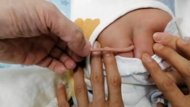 Baby Born With Tail: चमत्कार या बीमारी? 4 इंच लंबी पूंछ के साथ पैदा हुआ अनोखा बच्‍चा, डॉक्टर भी हुए हैरान