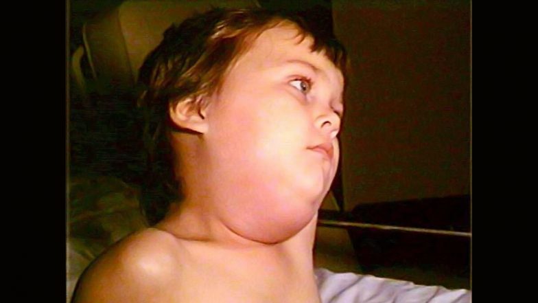 Mumps Virus: तेजी से फैल रहा गलसुआ वायरस का संक्रमण! जानें लक्षण-इलाज और बचाव के तरीके