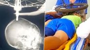 Shocking! 9 साल के बच्चे की खोपड़ी में धंसा साइकिल के पहिए का बोल्ट:  X-Ray की दर्दनाक तस्वीर आई सामने