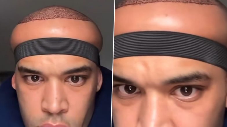 Viral News: ब्रिटिश टिकटॉकर ने सेलिब्रिटी क्लिनिक में करवाया हेयर ट्रांसप्लांट, ट्रीटमेंट के बाद सिर में आई सूजन