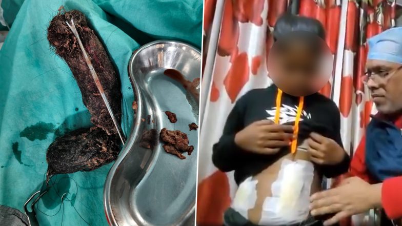 Hamirpur Shocker: बच्ची का पेट कर रहा था दर्द, एक्स रे करने के बाद डॉक्टर हुए हैरान, लड़की के पेट से निकाला 2 किलो बालों का गुच्छा, हमीरपुर की घटना (Watch Video)