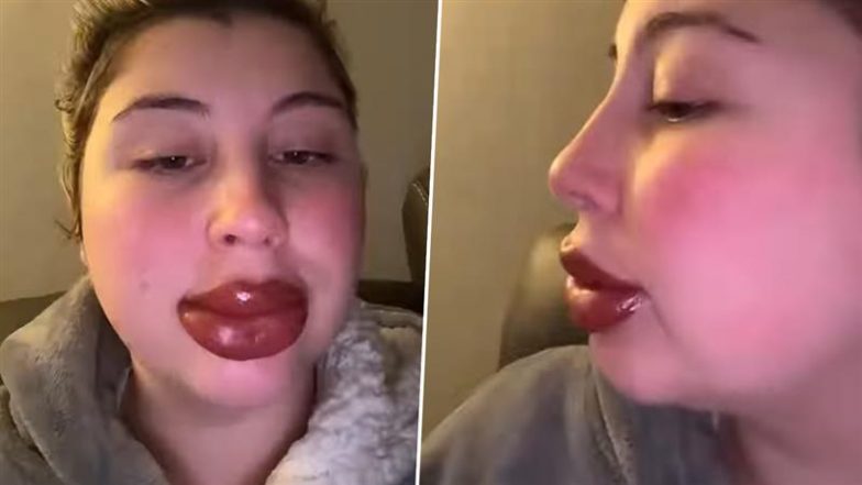 Beauty Treatment Goes Wrong: लिपस्टिक टैटू कराने के बाद महिला के होंठ गुब्बारे जैसे फूले, ब्यूटी ट्रीटमेंट के बाद का वीडियो वायरल