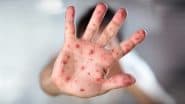 Measles outbreak in Mongolia: मंगोलिया में खसरे का कहर, बीमारों की संख्या 10 हजार के पार