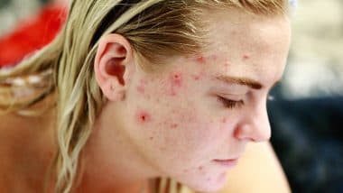 Home Remedies for Pigmentation: एक्ने और पिग्मेंटेशन से ऐसे पाएं छुटकारा, घरेलू नुस्खों से पहले टेस्ट कराना जरूरी