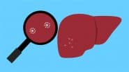 Hepatitis: थकान, बुखार और कमजोरी, कहीं ये हेपेटाइटिस तो नहीं! जाने इससे कैसे बचें?