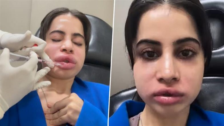 Uorfi Javed Viral Video: उर्फी जावेद ने वीडियो शेयर कर दिखाई दर्दनाक लिप फिलर हटाने की प्रक्रिया, फैन्स ने सराहा
