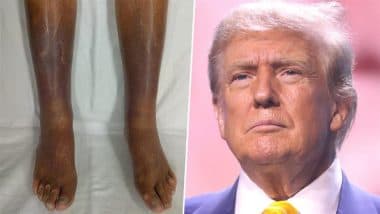 Chronic Venous Insufficiency: क्रॉनिक वेनस इंसफिशिएंसी क्या है, जिससे जूझ रहे हैं अमेरिकी राष्ट्रपति डोनाल्ड ट्रंप, जानें इस बीमारी के मुख्य कारण, लक्षण और उपचार Chronic Venous Insufficiency: क्रॉनिक वेनस इंसफिशिएंसी क्या है, जिससे जूझ रहे हैं अमेरिकी राष्ट्रपति डोनाल्ड ट्रंप, जानें इस बीमारी के मुख्य कारण, लक्षण और उपचार