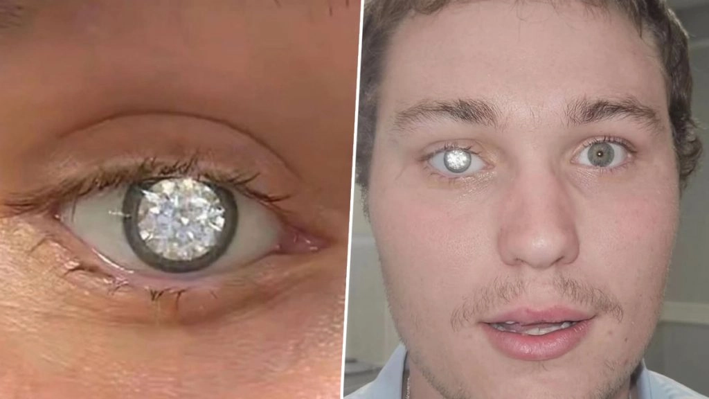 OMG! दुनिया की सबसे महंगी आंख! दाईं आंख की रोशनी हुई कम तो शख्स ने उसमें जड़वा लिया बेशकीमती हीरा (See Viral Pics)
