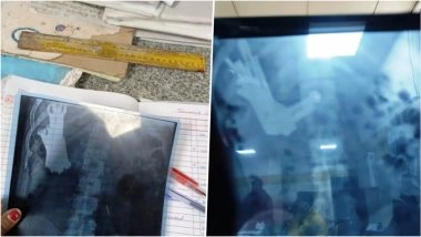 VIDEO: अंबेडकरनगर में अजीब मामला, नशे की हालत में युवक ने शरीर के अंदर डाली बोतल, डॉक्टरों ने सर्जरी कर बचाई जान