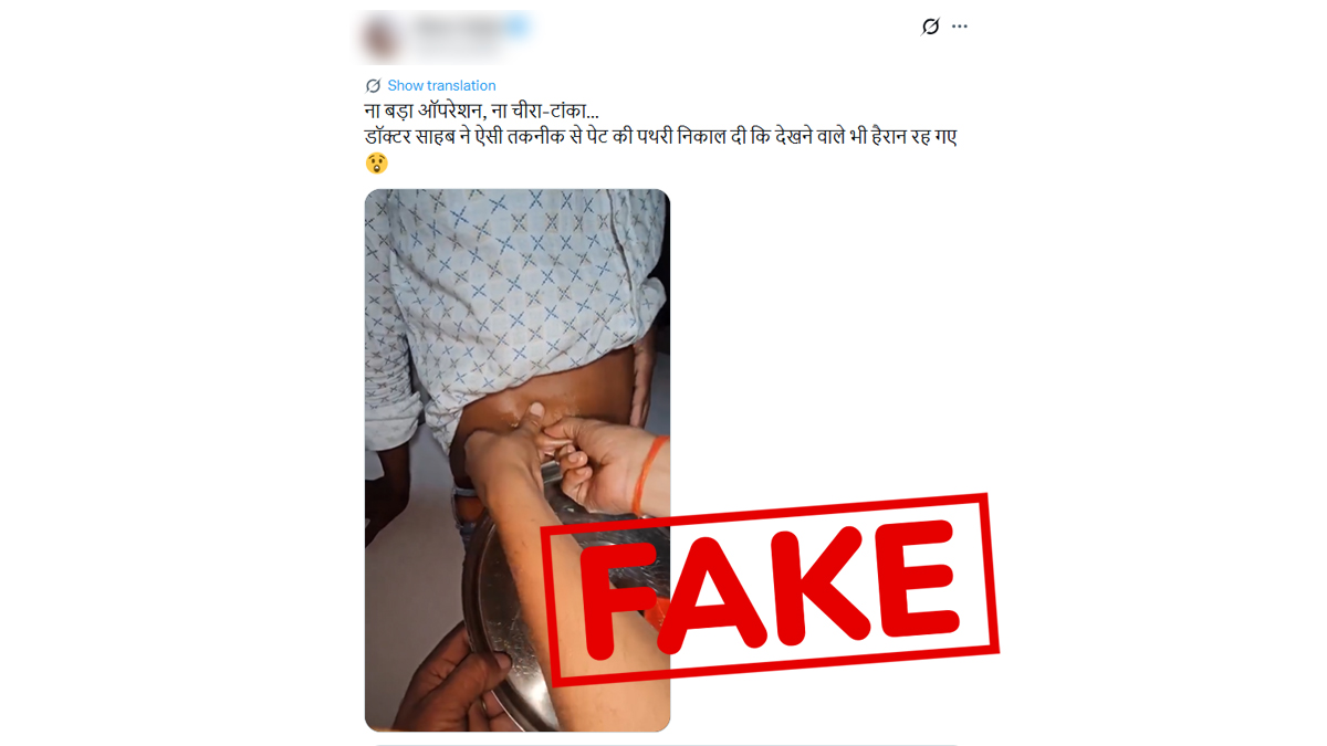 Fact Check: बिना ऑपरेशन पेट दबाकर हाथ से निकाल दी किडनी स्टोन? जानिए सोशल मीडिया पर वायरल वीडियो का मेडिकल सच